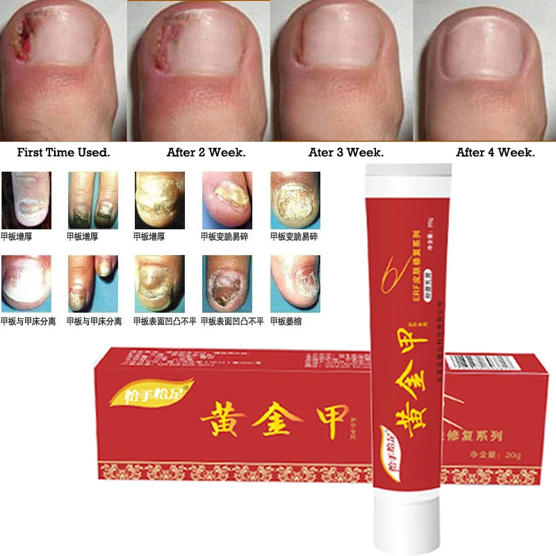 Fungus Nail Treatment Cream Onychomycosis Paronychia Anti Fungal Nail Infection Fights Bacteria