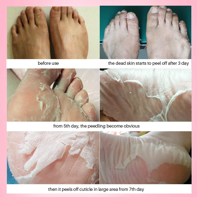 baby foot masque baby foot masque