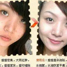 Уход за чувствительной кожей питает масло для кожи контроль акне натуральные растительные ингредиенты отбеливающий крем для лица