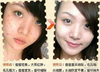

Free shipping Sensitive skin care Nourish the skin Oil Control Acne Natural plant ingredients whitening Facial Treatment Cream