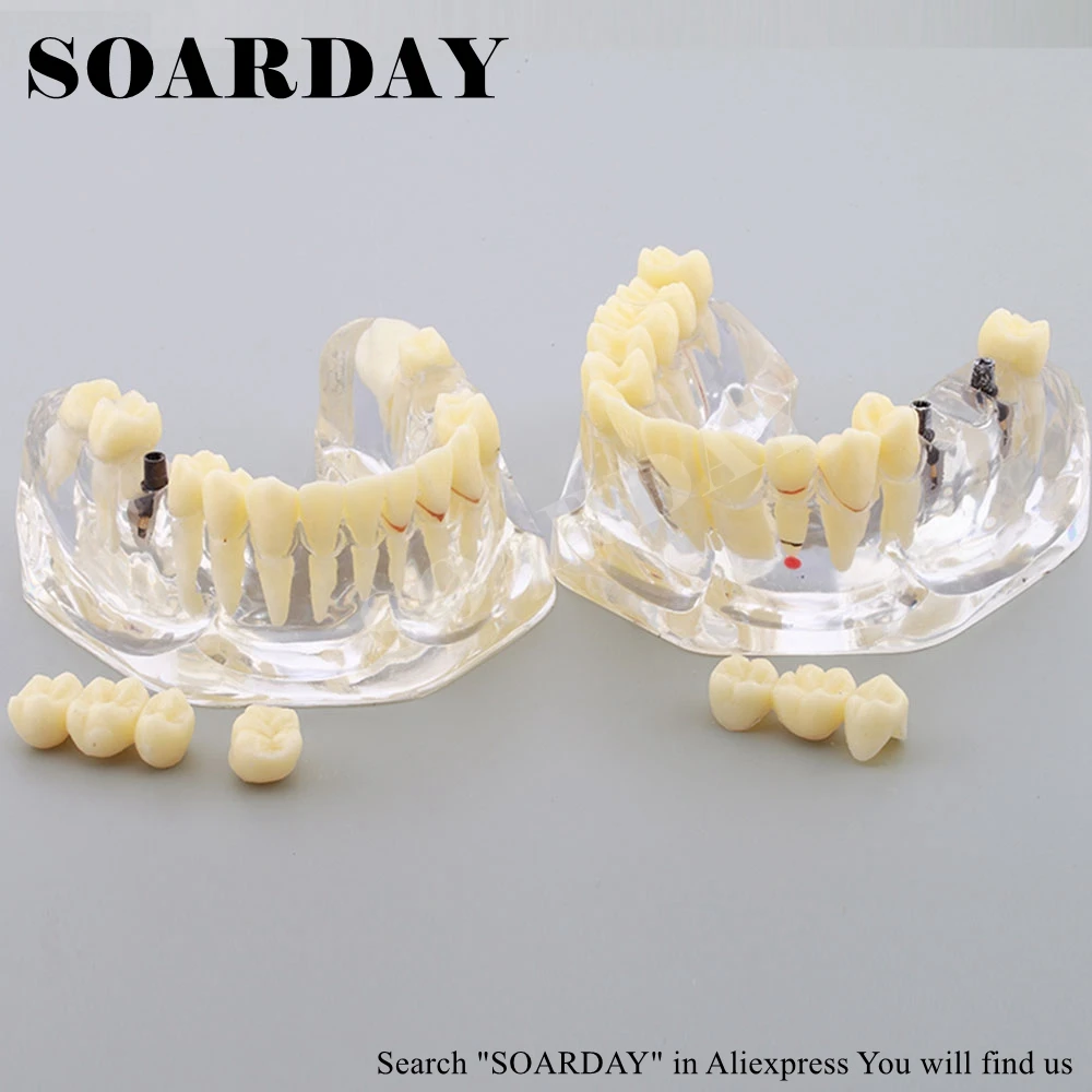 2 times Dental Pathological Model (5)
