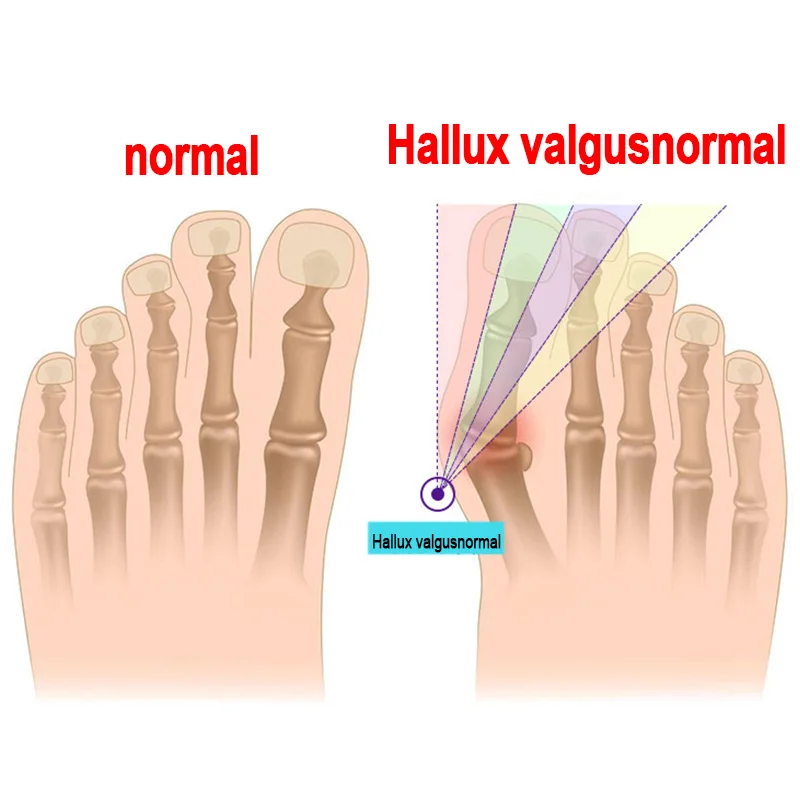 2pcs=1Pair Big Toe Hallux Valgus Corrector Orthotics Feet Care Bone Thumb Adjuster Correction Pedicure Socks Bunion Straightener