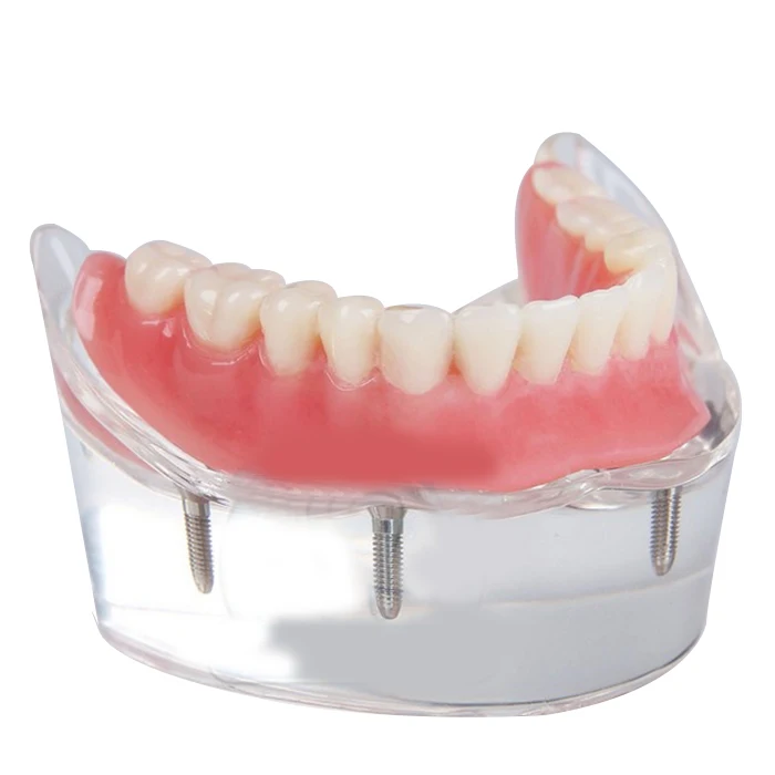 

Dental Teeth Model Overdenture Inferior with 4 Implants Demo
