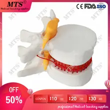 Human anatomy skeleton Spine Lumbar Disc Herniation Teaching Model medical instrume traumatic pistol spinal bone pathology model 2016 human lumbar disc herniation model demonstration model of lumbar vertebral spine model