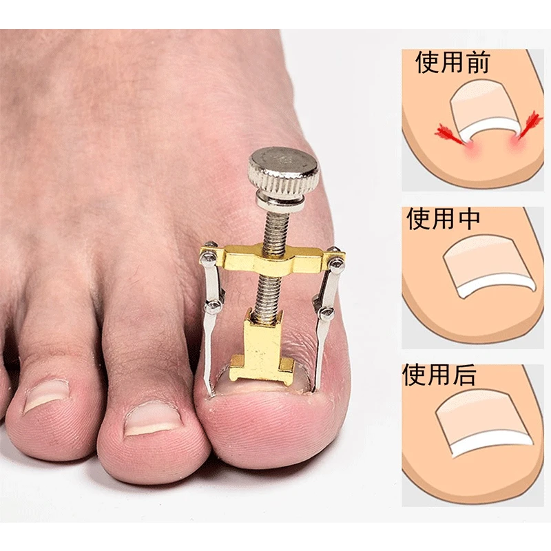 

Pedicure Orthotic Ingrown Toenails Pedicure Foot Nail Care Tool 1pc Professional Fixer Recover Correction Device Protector Tool