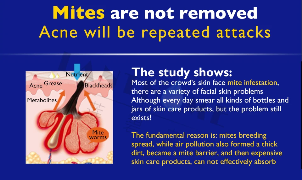 Уход за кожей и лицом от акне крем для удаления клещей средство по уходу за лицом от прыщей лечение шрамов и грибка мыло для тела