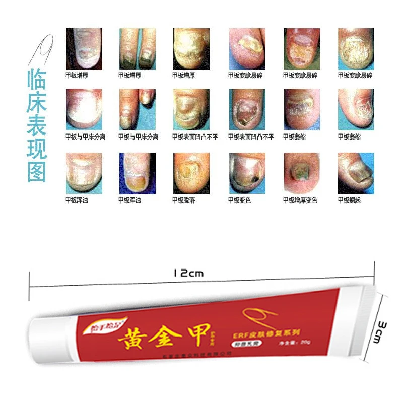 No box best fungus nail treatment cream onychomycosis paronychia anti No box Best Fungus Nail Treatment Cream Onychomycosis Paronychia Anti