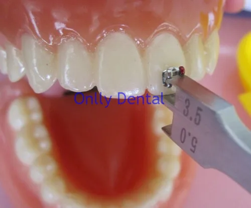 Dental strip-type orthodontic braces locator (4)