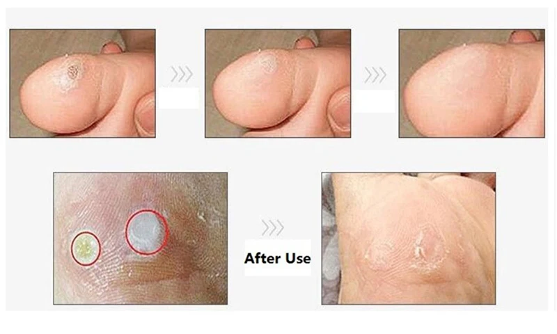 6-Pcs-Foot-Corn-Remover-Foot-Callus-Remover-Caorn-Health-Medical-Foot-Corn-Plaster-Patch-Relieving (4)