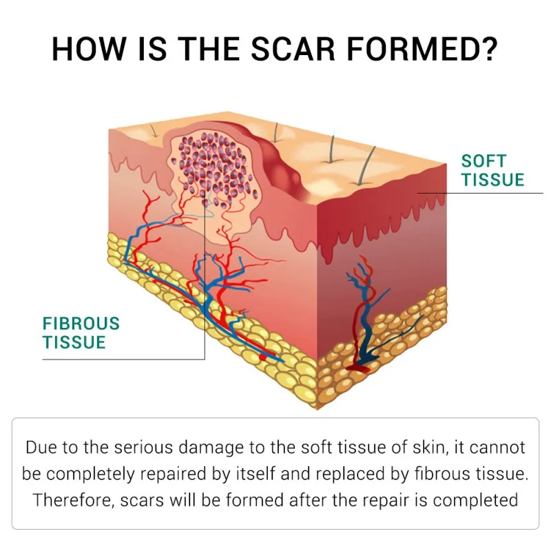 30 г Новое лицо Удаление Шрама от акне крем Ремонт уход за кожей для обработки шрамов удалить стрейч Знаки отбеливающий крем Красота
