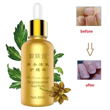 30 мл лечение онихомикоза Лечение грибка ногтей против грибкового лака для ног Уход за ногами эссенция отбеливание ног кутикулы