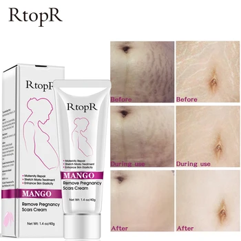 

Mango Remove Pregnancy Scars Acne Cream Stretch Marks Treatment Maternity Repair Anti-Aging Anti Winkles Firming Body Creams