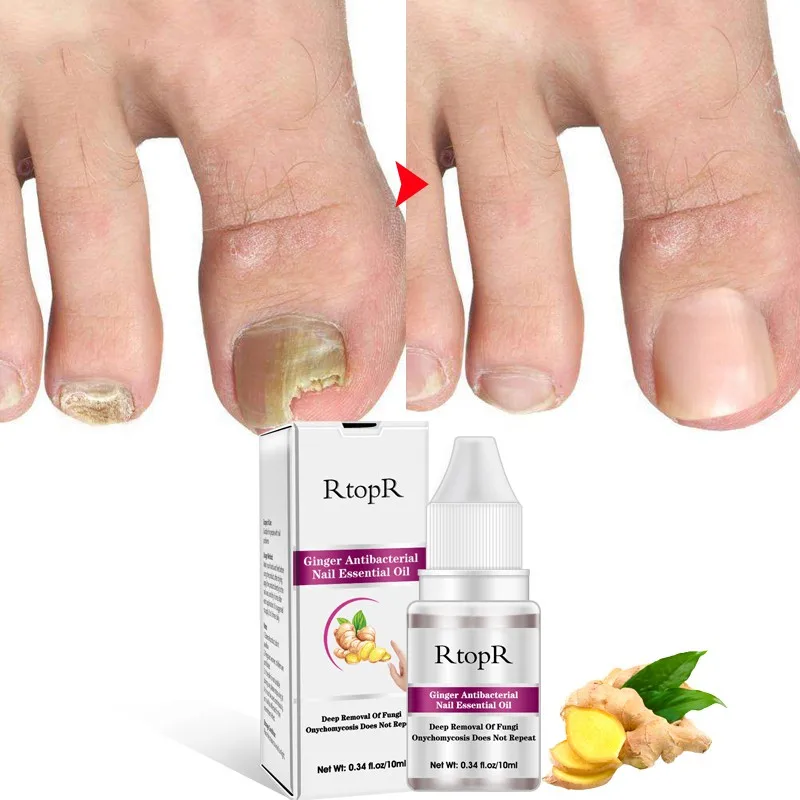 Лечение грибковых ногтей эссенция отбеливание ногтей и ног ногтей имбирь антибактериальное эфирное масло для ногтей