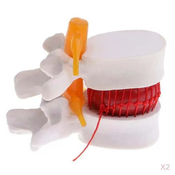 2PCS Magnify 2 Times Human Spine Lumbar Vertebrae Degenerative Disc Skeleton Model Educative Science Toy Lab Study Kits