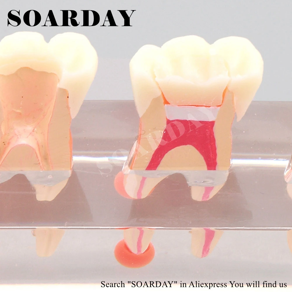 SOARDAY эндодонтические восстановление модели обучения Связь модели патологических Дисплей кариеса