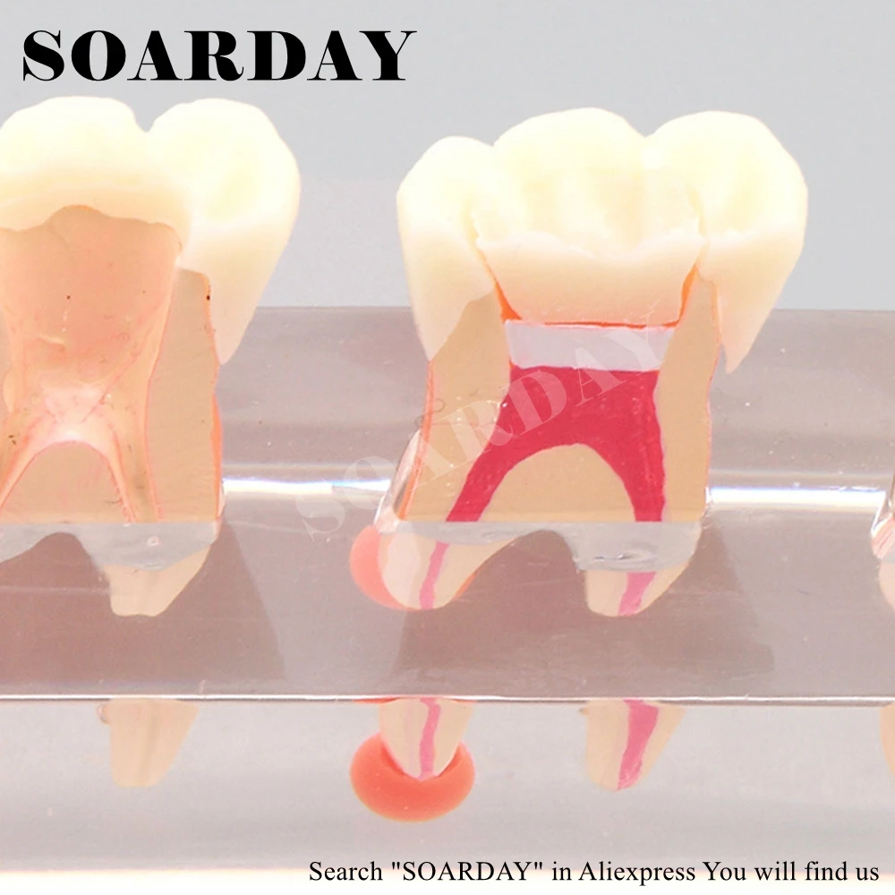 Dental Endodontic Restoration Model (4)