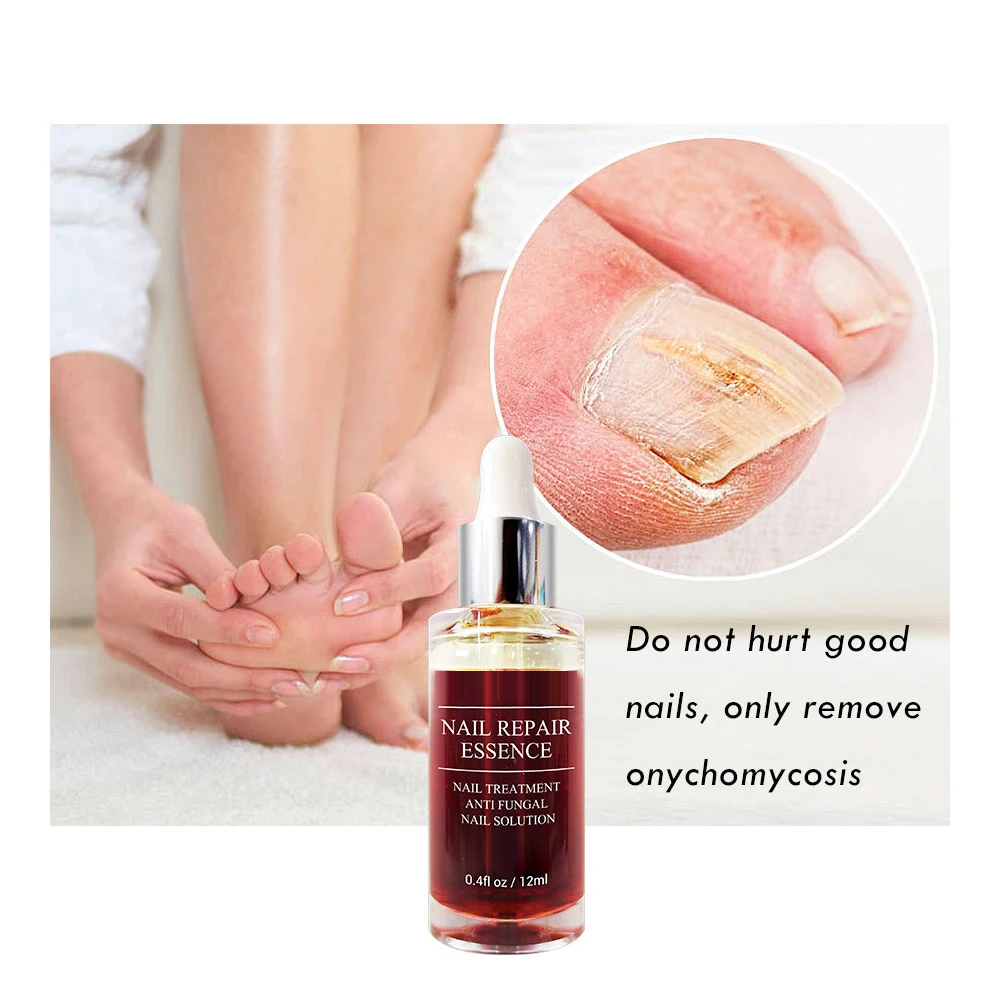 WHAT IS NAIL FUNGUS AND PREVENTION 2 Nail fungus