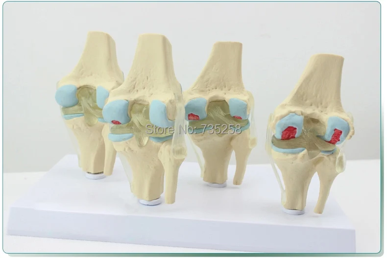 

Human Knee Degenerative Diseases Presentation Model,Knee Joint Pathology Model