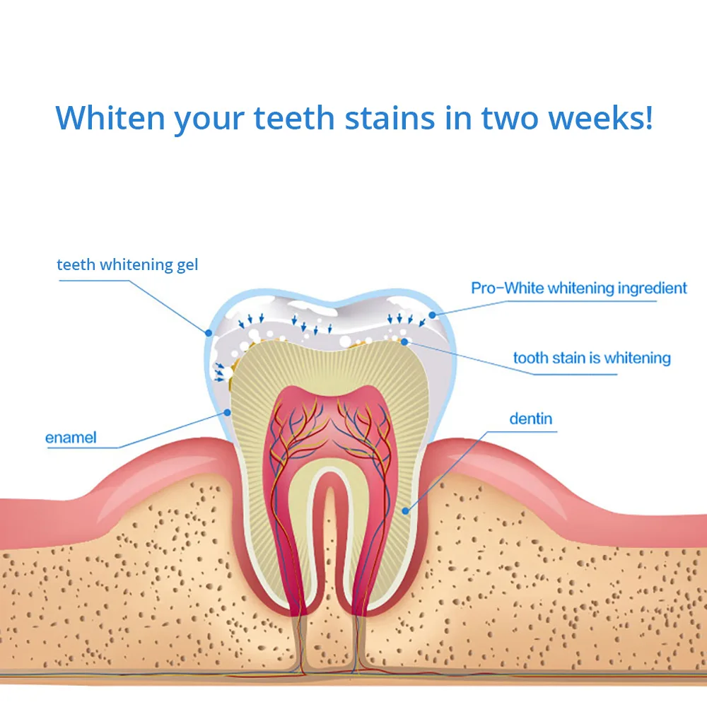 tooth whitening kit (3)