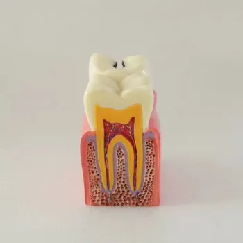

Dental 6 Times Caries Comparation Teeth Model