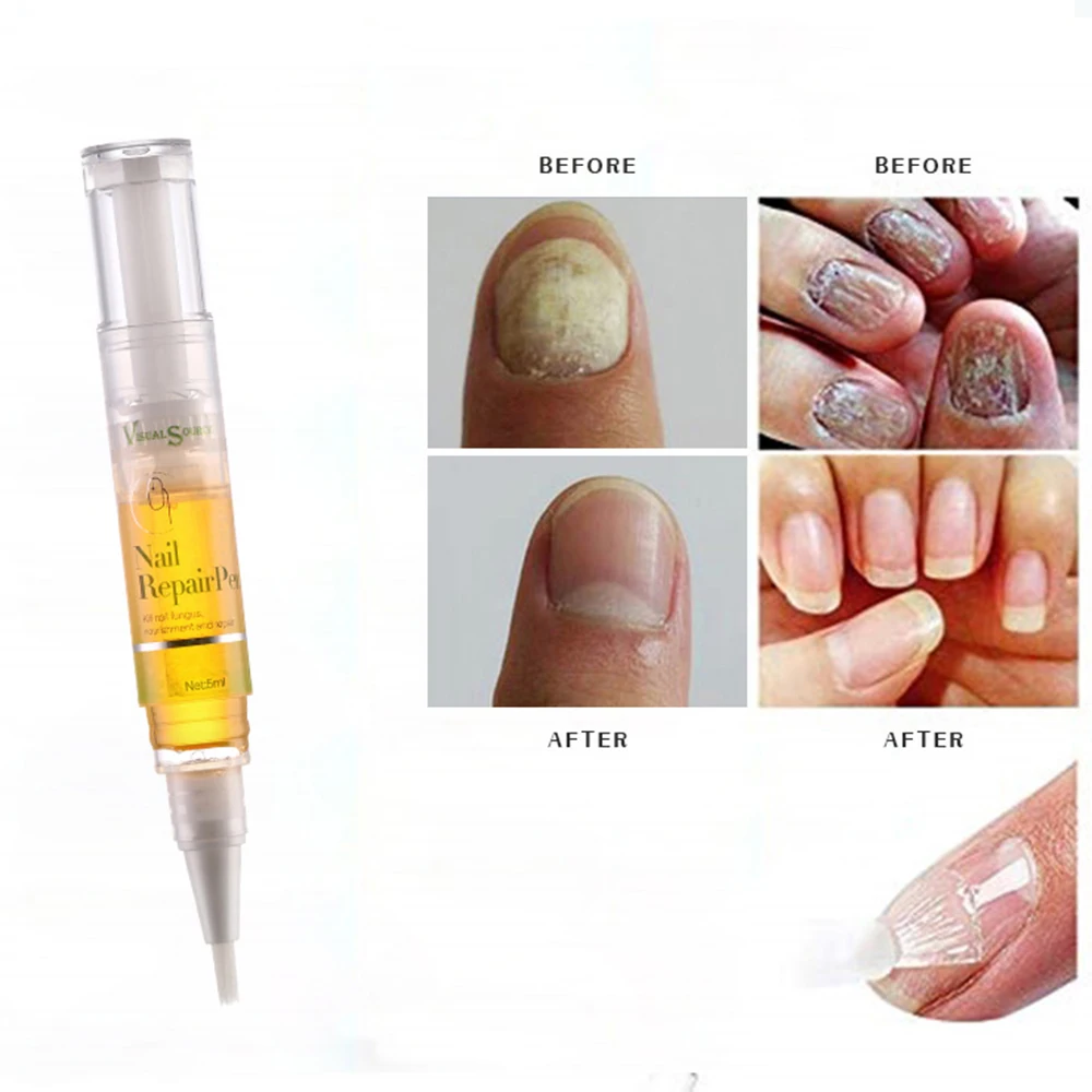 

5ML Nail Treatment Liquid Pen Anti Fungal Nail Infection Toe Moisturize Nail Oil Repair Cuticle Remover Nail Care TSLM1