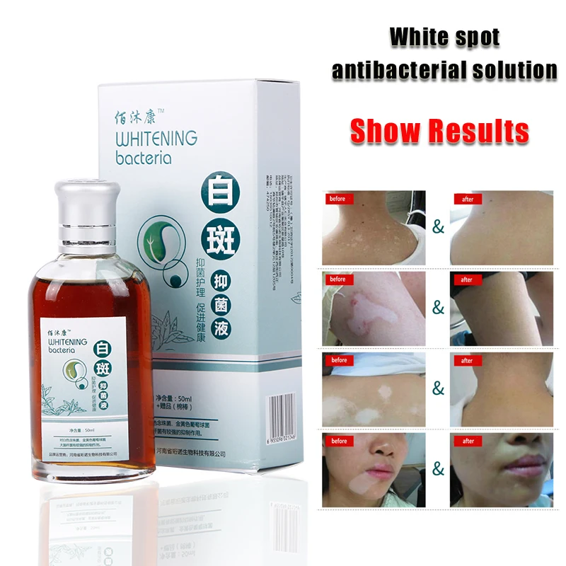 

Skin Treatment White Spot Disease Liquid Pigment Melanin Promoting Liniment Skin Vitiligo Leukoplakia Disease Treatment 50ml