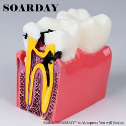 SOARDAY шесть раз кариеса сравнительная модель демонстрационная модель для обучения Связь полости рта модель для стоматологов