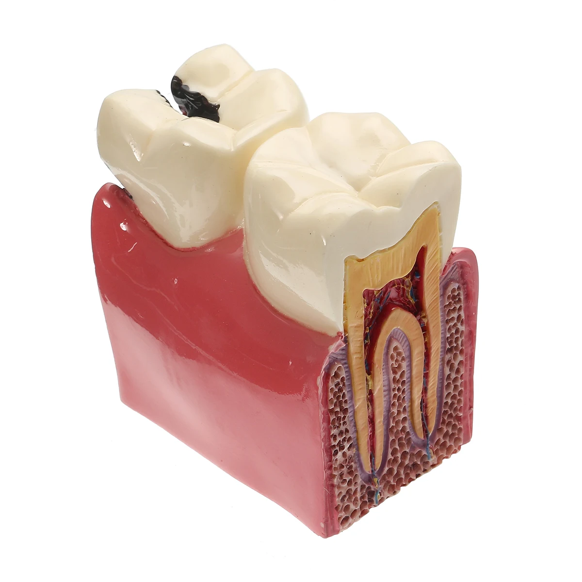 

6 X Dentist Pathologies Caries Comparison Tooth Decay Model Denture Teeth Model For Medical Science Dental Teaching Study