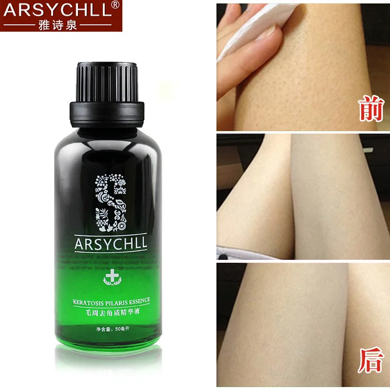 

Exfoliator Essence to Goose Bumps Wool Bursa Inflammation Skin Care Apply To Keratosis Pilaris Treatment