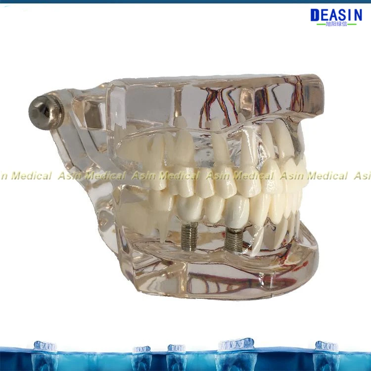 Новая модель зубного имплантата зубы с нервом прозрачная патологическая модель ремонта обучающая демонстрационная модель