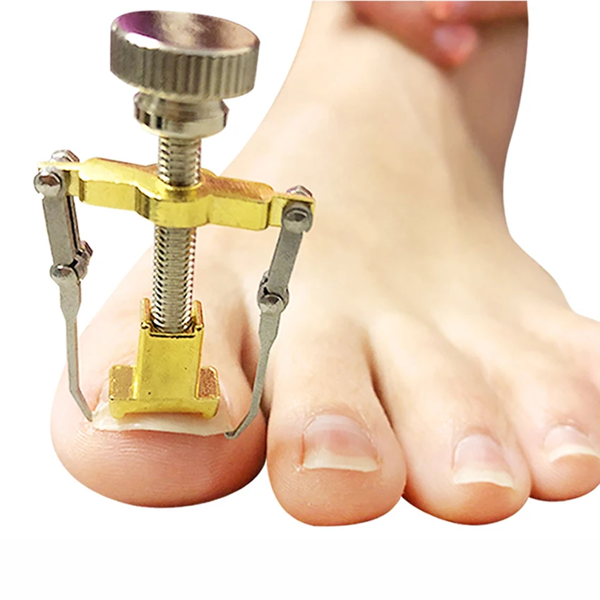 

Ingrown toe nails pedicure foot nail care tools feet file orthotic acronyx ingrowing nail onyxis toes bunion corrector
