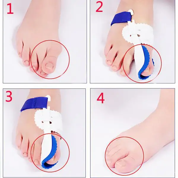 Kesoto 1Pair Night Sleeping Splint Big Toe Straightener Bunion Hallux Valgus Correctors Treat Pain in Hallux Valgus High Quality