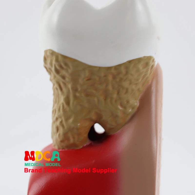 Модель стоматологической анатомии, увеличение зуба, кариес, Дисплей десен, модель медицинского обучения MYC010