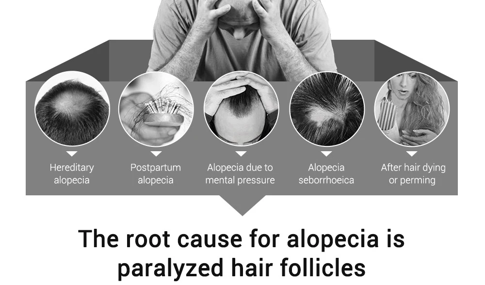 LANBENA 20 мл эссенция для роста волос Быстрый мощный Уход за волосами эфирное масло лечение мужчин t Предотвращение выпадения волос продукты для мужчин