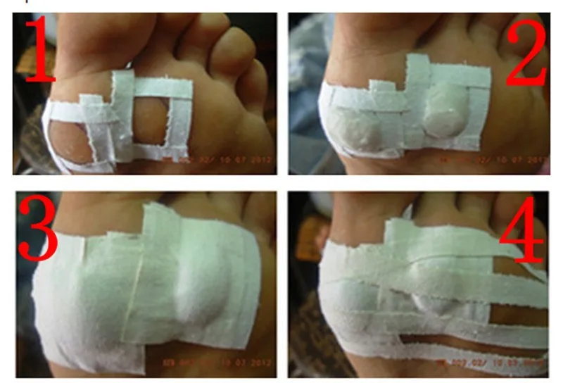 USD States finger treatment plantar on Dollar Stop118 the Last warts bump foot discount United or for or Chinese Natural the removal de verruga machine gel pomada warts 10 USD States finger treatment 10