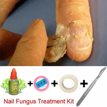 Китайская медицина, Лечение грибка для пальцев ног, против грибковой инфекции ногтей, эссенция для лечения Ногтей, Уход за ногтями, лосьон