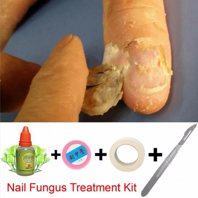 Chinese Medicine Herbs Toe Nail Fungus Treatment Anti Fungal Nail