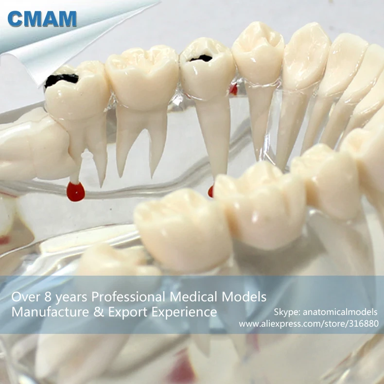 CMAM/12594 Dental-патологическая Стоматологическая модель, 2X в натуральную величину, полости рта человека стоматологический медицинский анатомическая модель