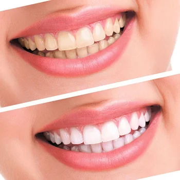 

Whitening Teeth Tooth Gel Set Kit Dental Oral Care Bleaching System Effective Whitener KG66