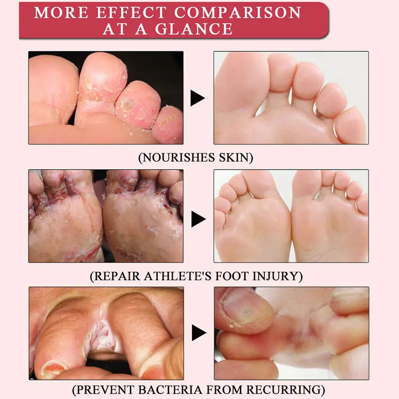Травяное лечение ног против грибковой инфекции onychomicosis Paronychia ...