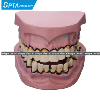 

Dental Implant Disease Teeth Model Smoking Decay Caries Tooth Model Denture For Dentist Medical Science Teaching Study