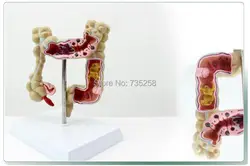 Человека двоеточия модель болезни, lntestinal анатомическая модель, толстой модель