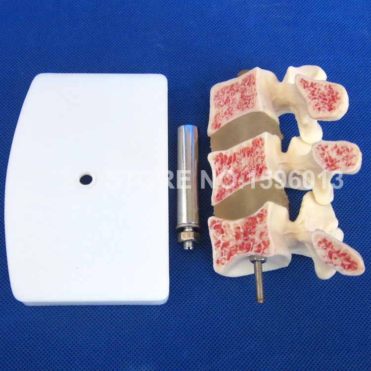 134 osteoporosis model (5)