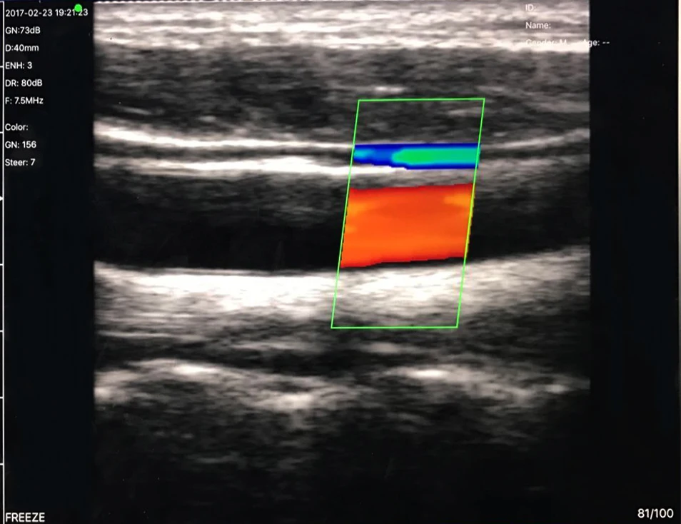 Linear Series Wireless Probe Type Ultrasound Scanner(Deep blue head (1)