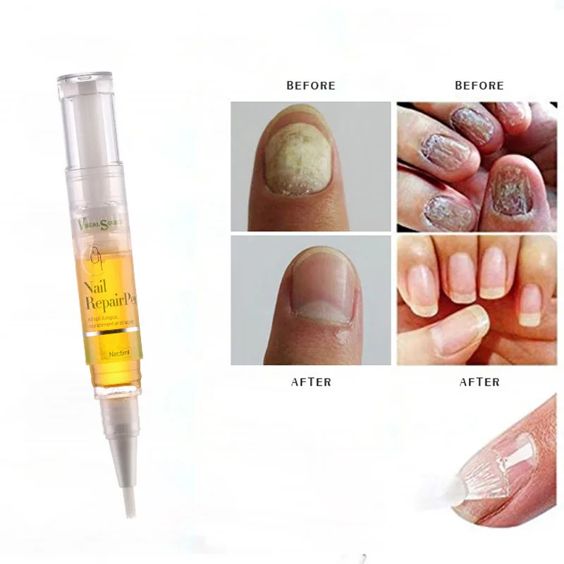 Hot 1pcs Nail Repair Anti Fungal Treatment Pen Onychomycosis Paronychia Infection Herbal Toe Finger Nutrition Health | Красота и