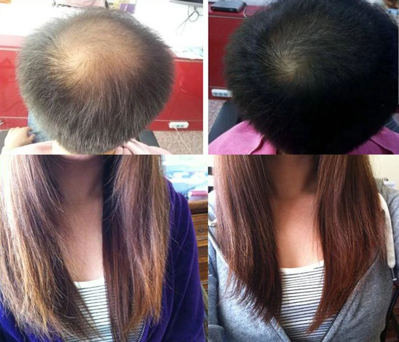 Andrea роста волос против выпадения волос лечения Для мужчин t Предотвращение более выпадения волос Масло жидкое средства по уходу за волосами для Для мужчин и Для женщин