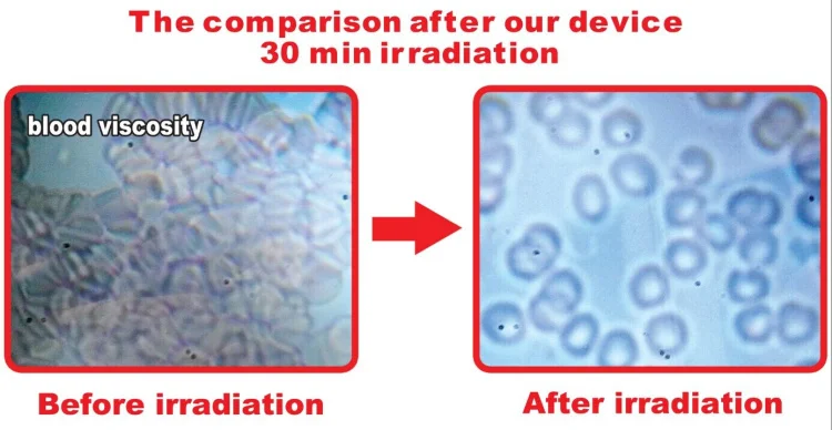 

Soft Low Level Wrist watch laser Blood cleaner for Allergic Rhinitis tinnitus