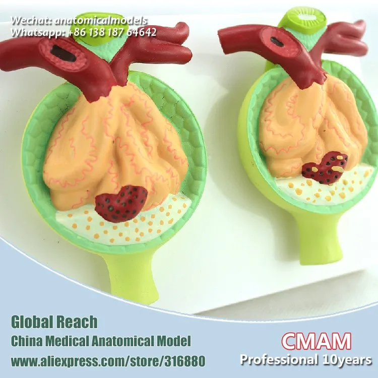 CMAM/12436 Nephron Diseases, 300X Life size, Genitourinary Medical Teaching анатомическая модель