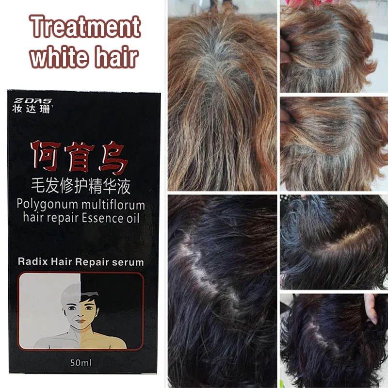 Традиционная китайская медицина, лечение белых волос, серый, черный, жидкий, уфимское управление, для подростков, средство для удаления белых волос
