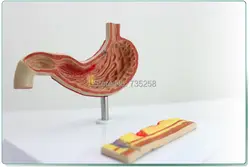 Желудка модель, гастрит Дисплей модель, язвенной модель, желудка анатомия модель